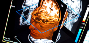 Brain scan